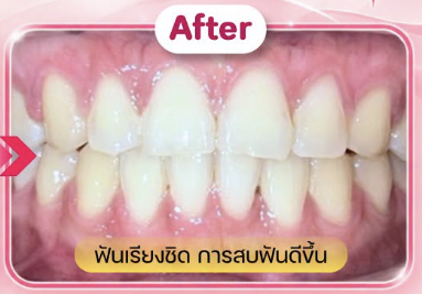 หลังรักษา — รีวิวเคส จัดฟัน