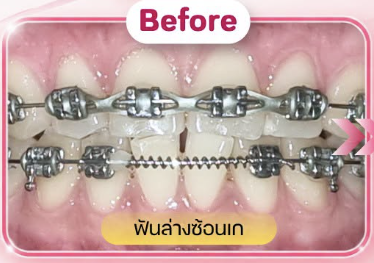 ก่อนรักษา — รีวิวเคส จัดฟัน