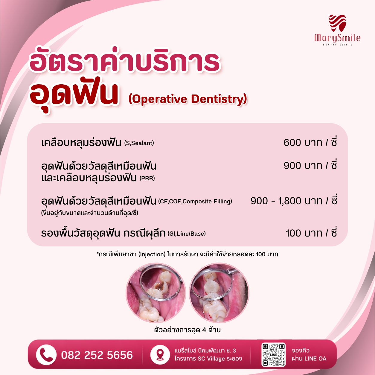 อุดฟัน