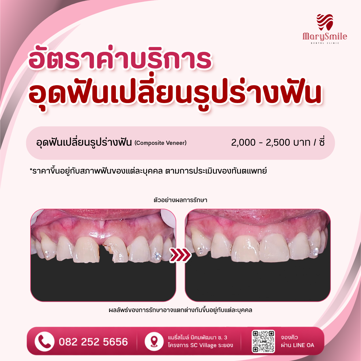 อุดฟันเปลี่ยนรูปร่างฟัน