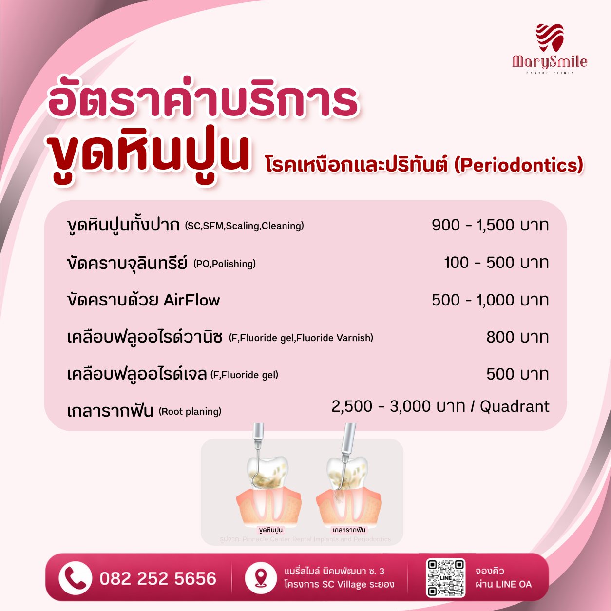 ขูดหินปูน