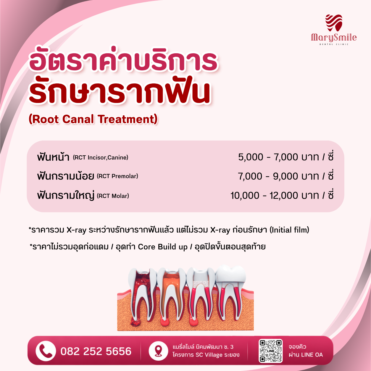 รักษารากฟัน