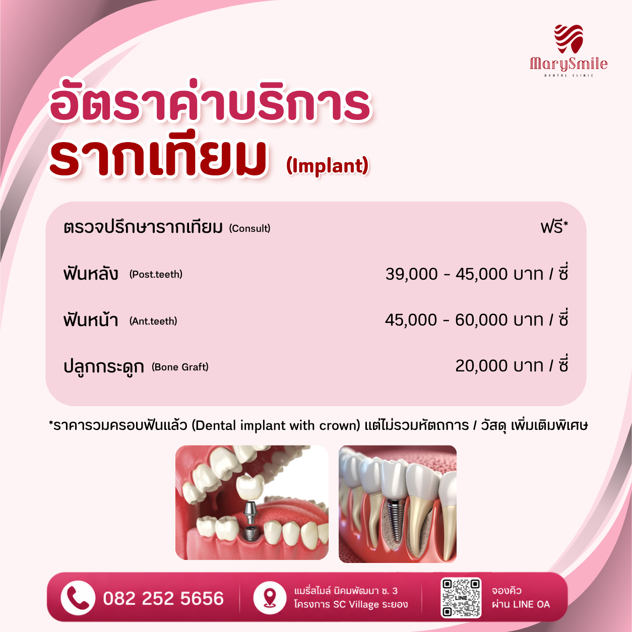 รากฟันเทียม