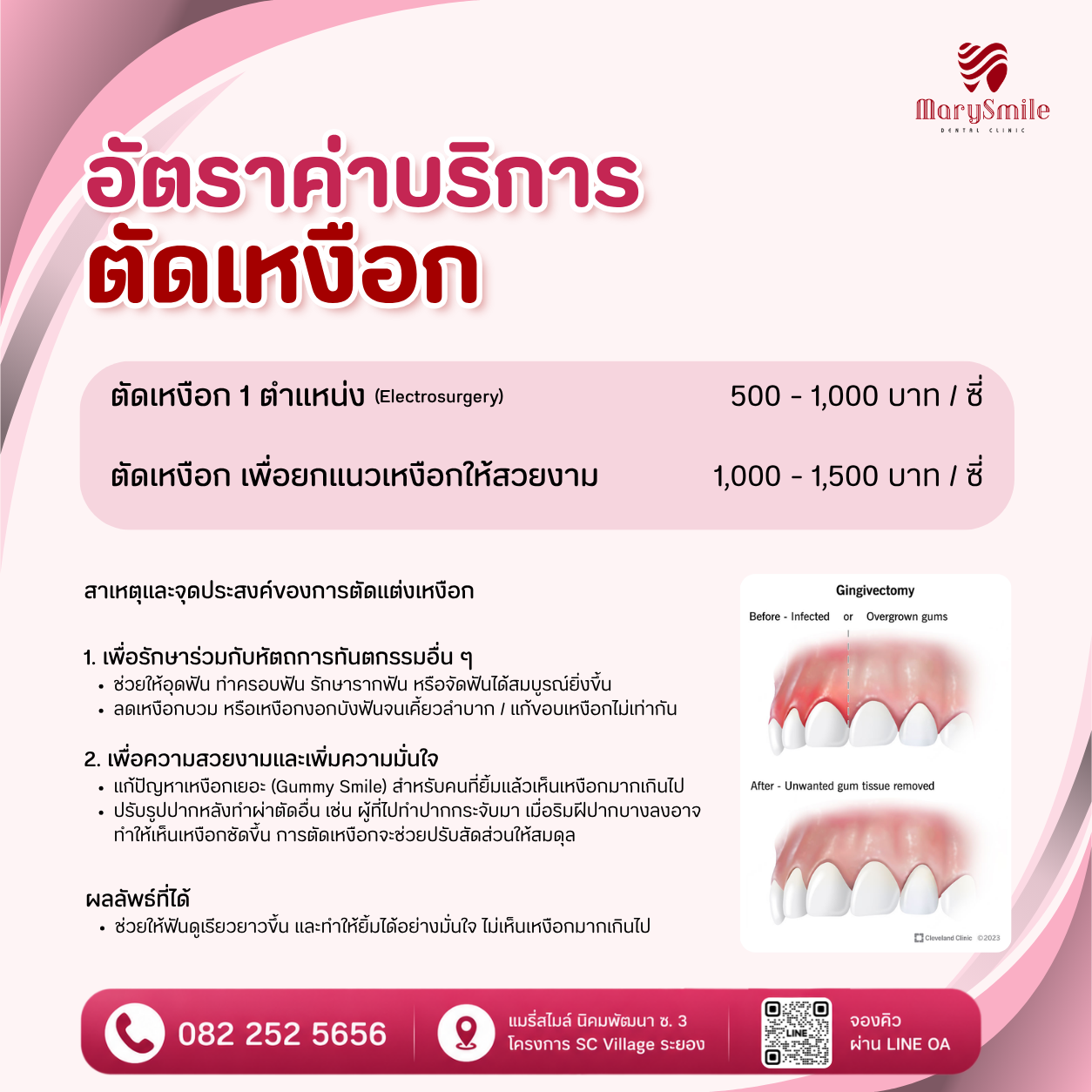 ตัดเหงือก