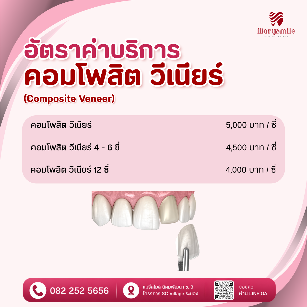วีเนียร์และออกแบบรอยยิ้ม