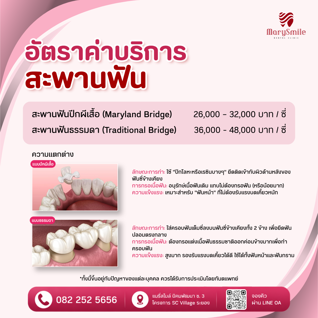 ครอบฟัน สะพานฟัน และฟันปลอม